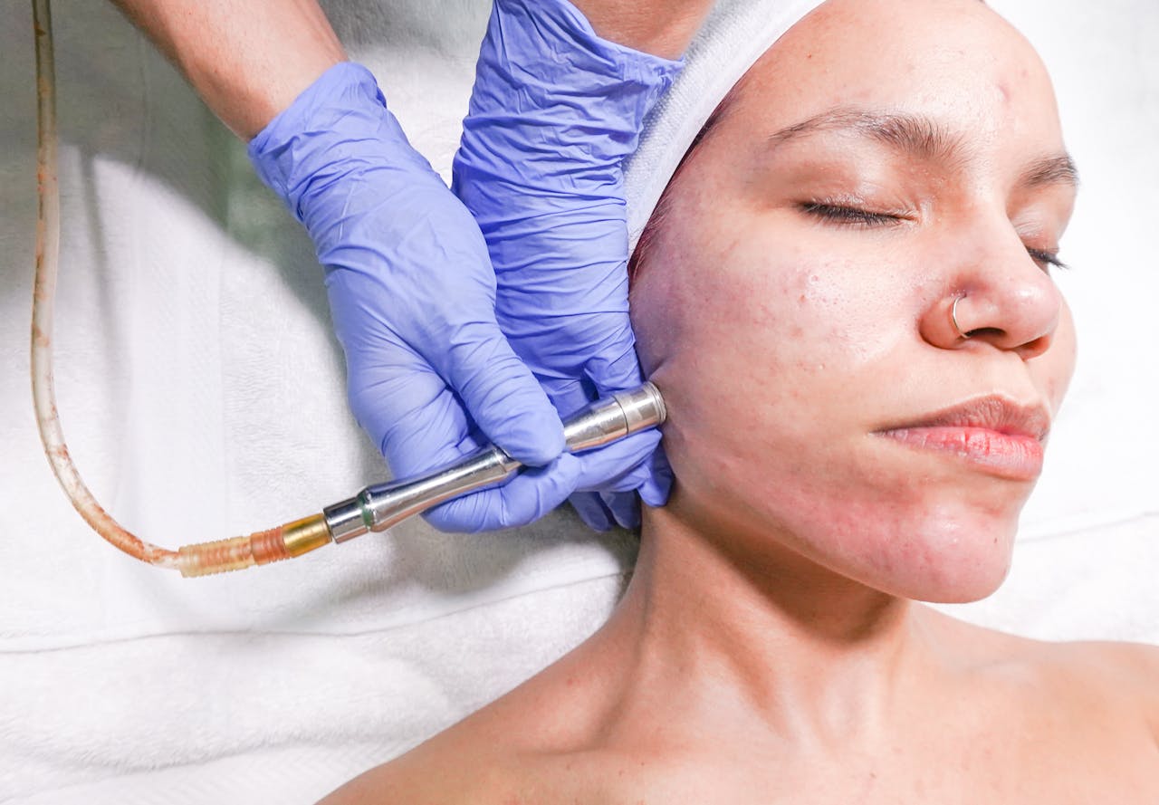 microdermabrasion